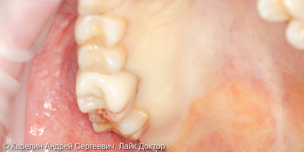 Отсроченая пластика слизистой, имплантация и удаление зуба мудрости - фото №4