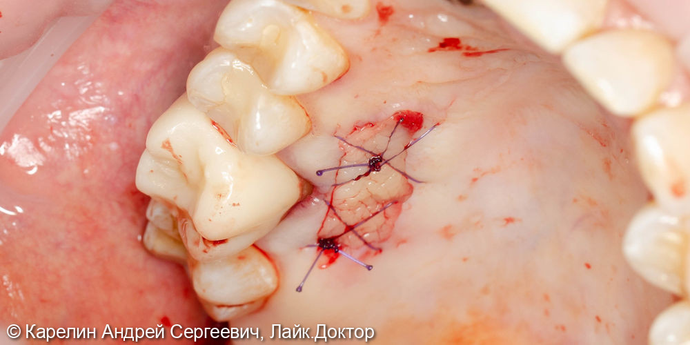 Отсроченая пластика слизистой, имплантация и удаление зуба мудрости - фото №5