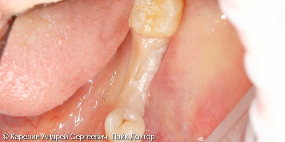 Отсроченая пластика слизистой, имплантация и удаление зуба мудрости - фото №8