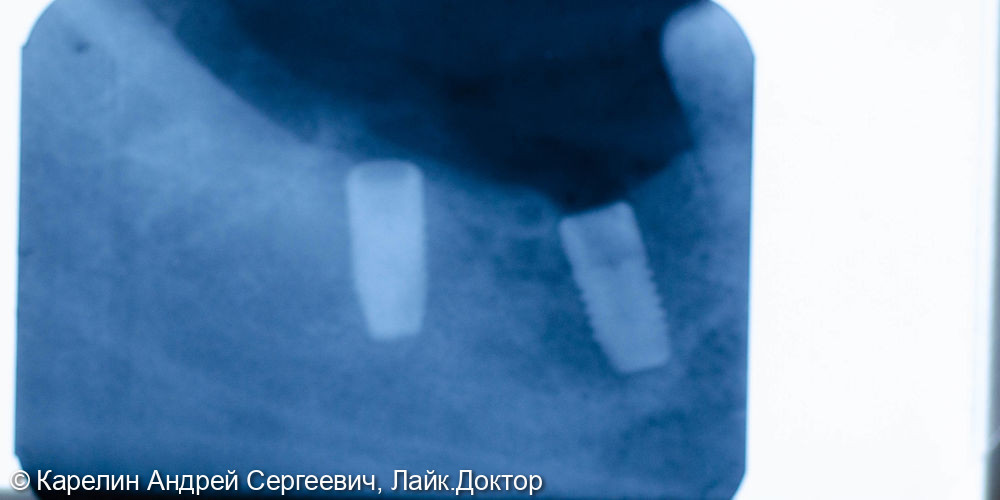 Отсроченая пластика слизистой, имплантация и удаление зуба мудрости - фото №12