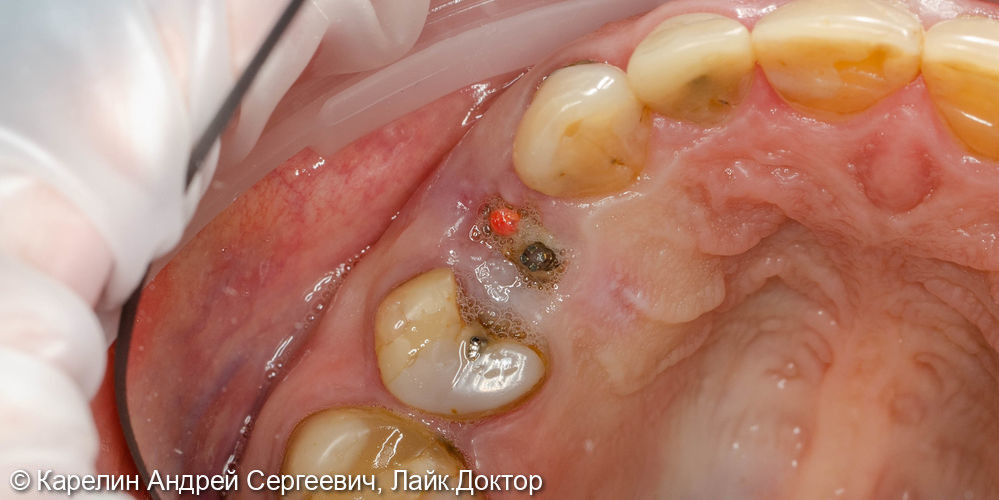 Удаление радикса зуба 2.4 с одномоментной имплантацией - фото №1