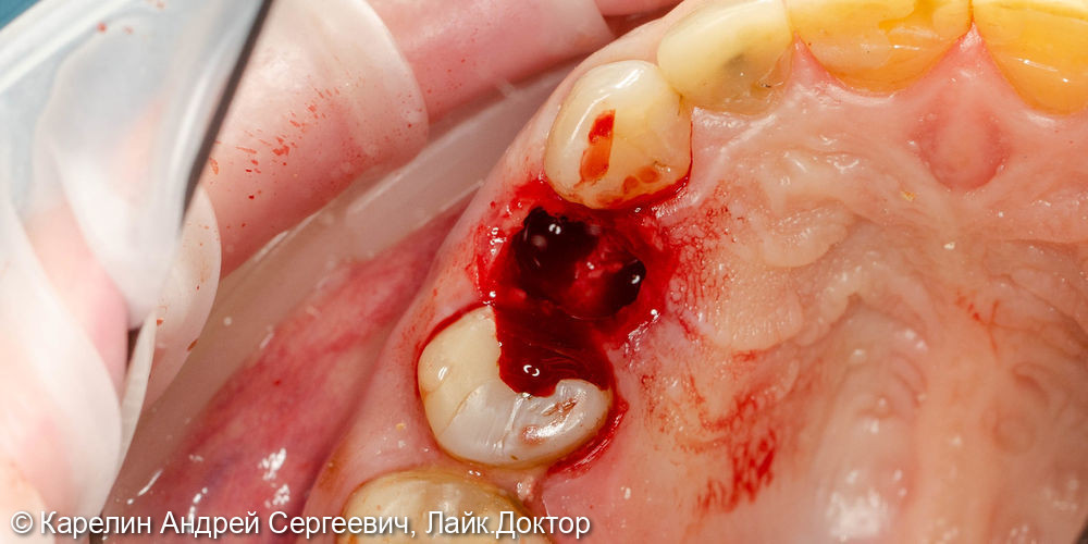 Удаление радикса зуба 2.4 с одномоментной имплантацией - фото №2