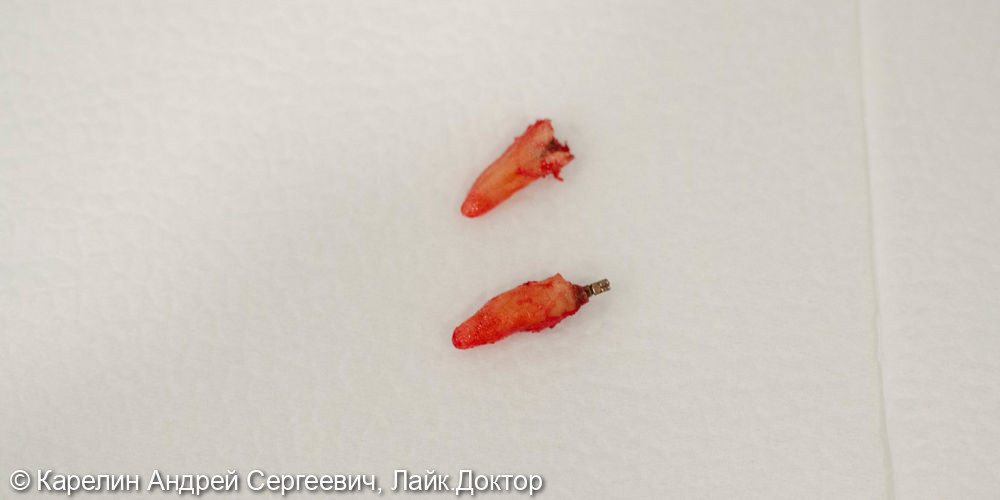 Удаление радикса зуба 2.4 с одномоментной имплантацией - фото №3