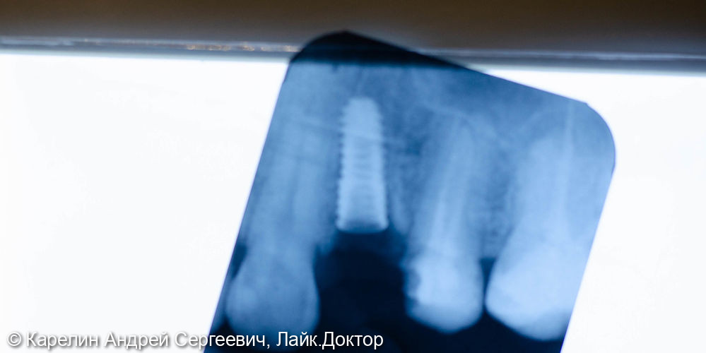 Удаление радикса зуба 2.4 с одномоментной имплантацией - фото №5