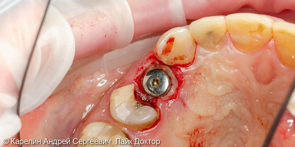 Удаление радикса зуба 2.4 с одномоментной имплантацией - фото №6