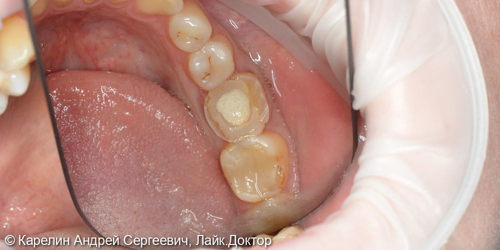 Атравматическое удаление зуба 3.6 и одномоментная имплантация - фото №1