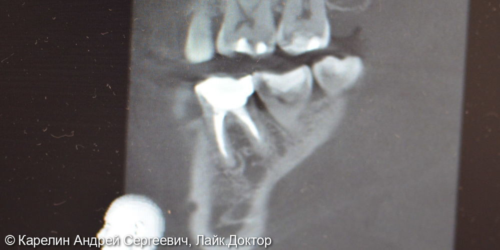 Атравматическое удаление зуба 3.6 и одномоментная имплантация - фото №2