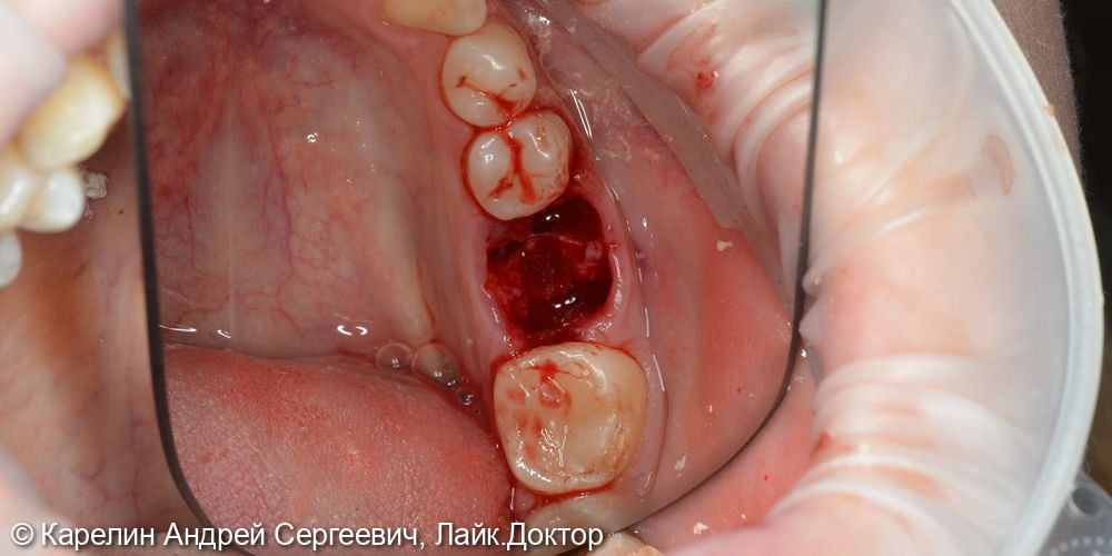 Атравматическое удаление зуба 3.6 и одномоментная имплантация - фото №3