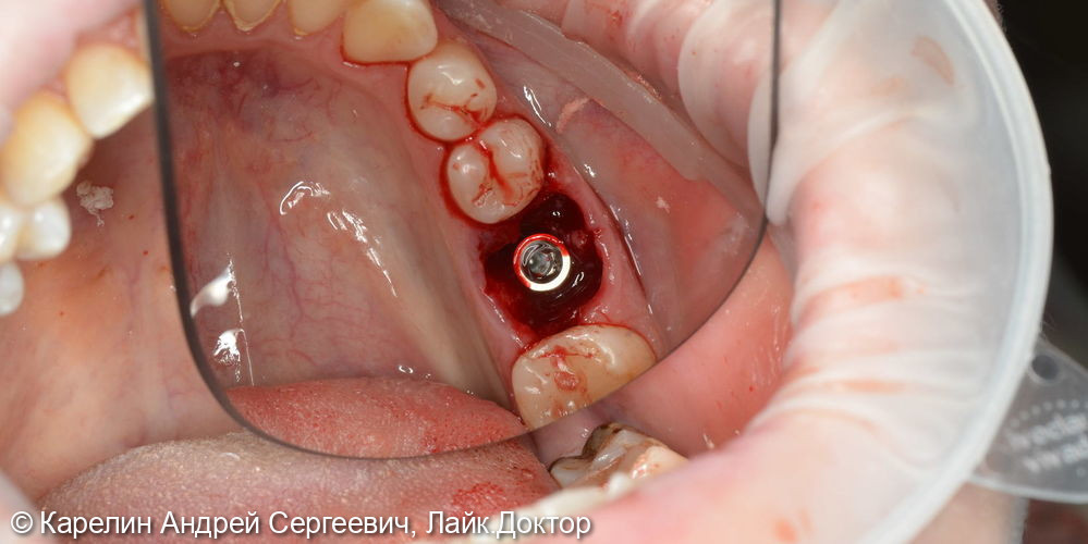 Атравматическое удаление зуба 3.6 и одномоментная имплантация - фото №4