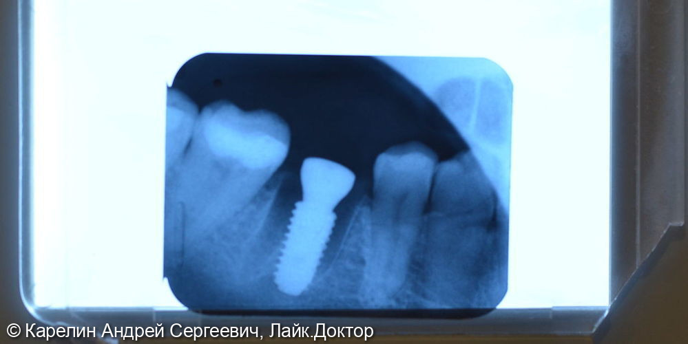 Атравматическое удаление зуба 3.6 и одномоментная имплантация - фото №5