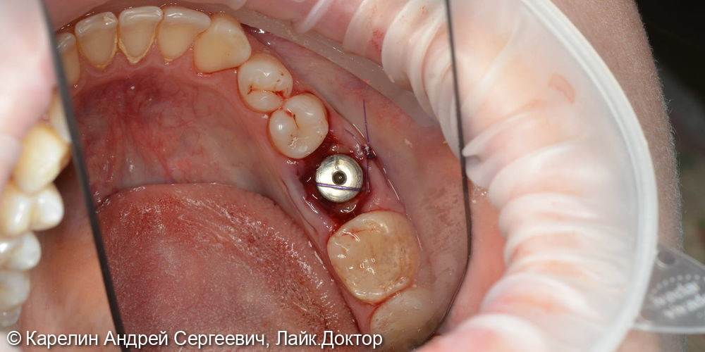 Атравматическое удаление зуба 3.6 и одномоментная имплантация - фото №6