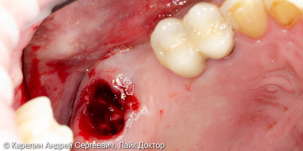 Удаление зуба мудрости и установка 2 имплантатов - фото №1