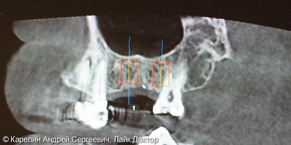 Удаление зуба мудрости и установка 2 имплантатов - фото №3