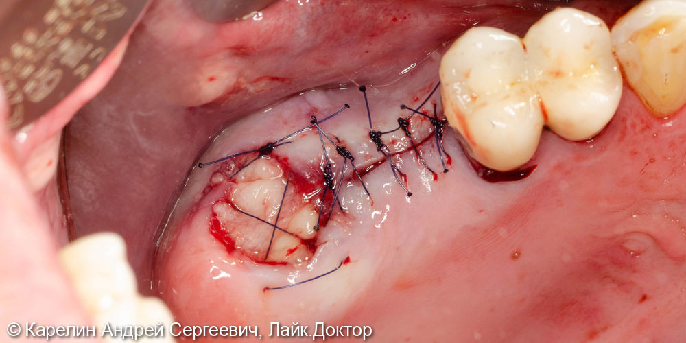 Удаление зуба мудрости и установка 2 имплантатов - фото №5