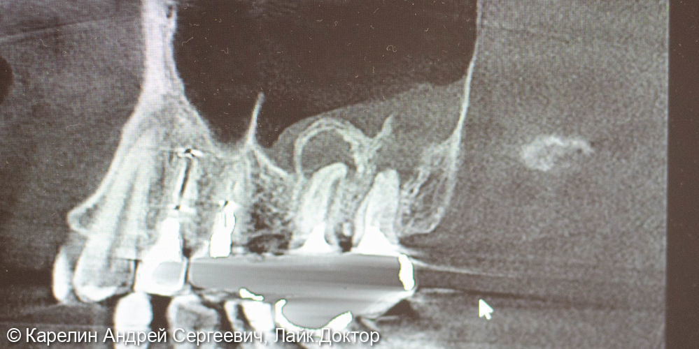 Отсроченное удаление с закрытием перфорации гайморовой пазухи, последующая имплантация одномоментно с синуслифтингом - фото №2