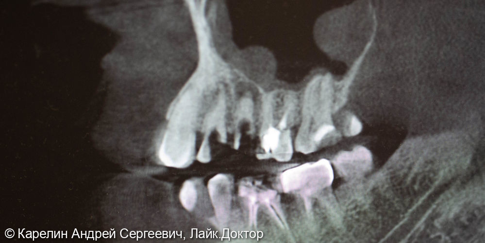 Удаление, отсроченная имплантация и протезирование зубов 1.4 и 1.5 - фото №2