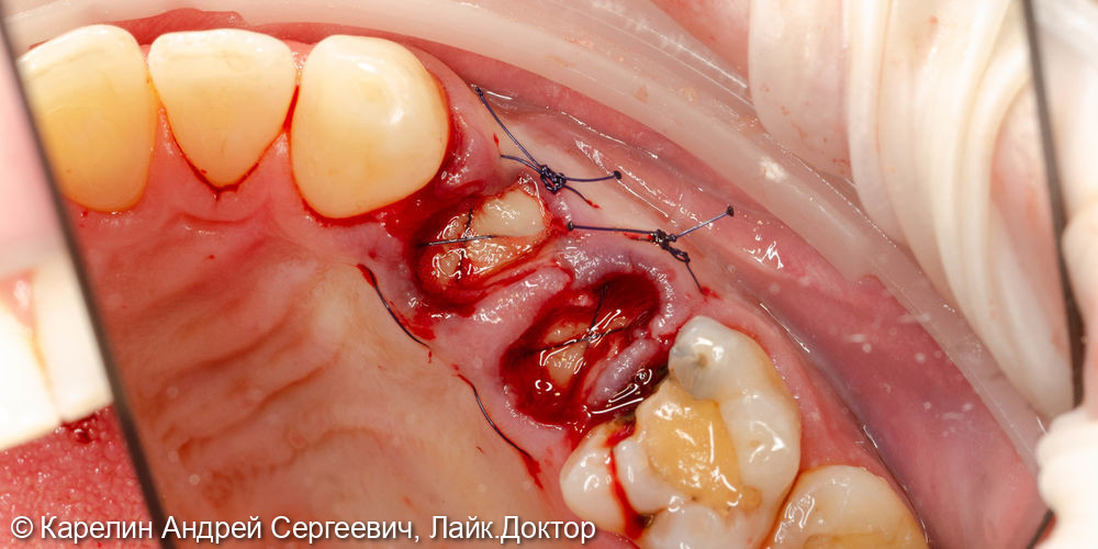 Удаление, отсроченная имплантация и протезирование зубов 1.4 и 1.5 - фото №3