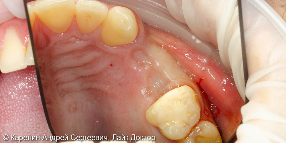 Удаление, отсроченная имплантация и протезирование зубов 1.4 и 1.5 - фото №4