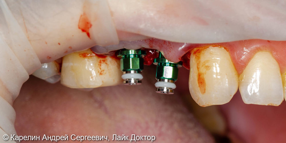 Удаление, отсроченная имплантация и протезирование зубов 1.4 и 1.5 - фото №5