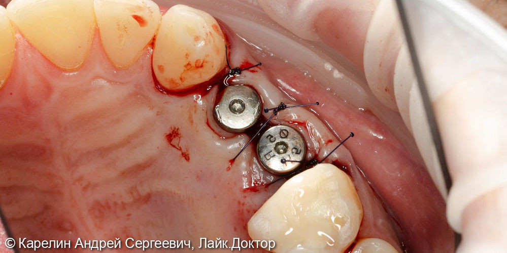 Удаление, отсроченная имплантация и протезирование зубов 1.4 и 1.5 - фото №6