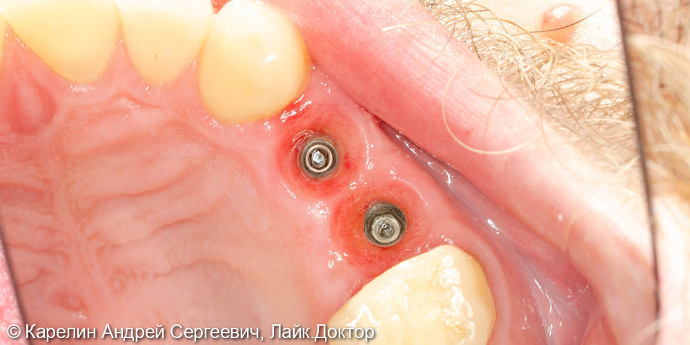 Удаление, отсроченная имплантация и протезирование зубов 1.4 и 1.5 - фото №8