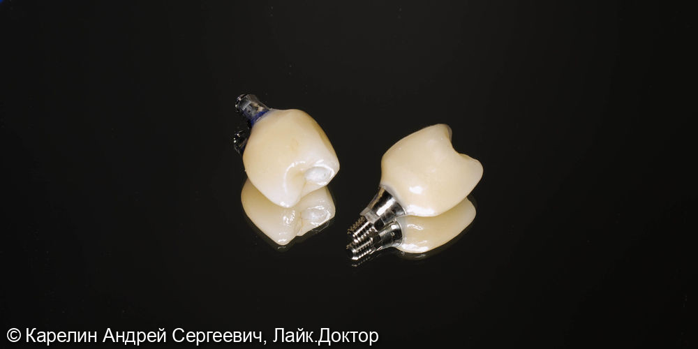 Удаление, отсроченная имплантация и протезирование зубов 1.4 и 1.5 - фото №9