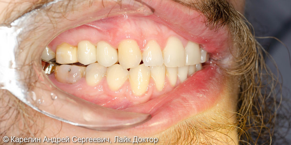 Удаление, отсроченная имплантация и протезирование зубов 1.4 и 1.5 - фото №10