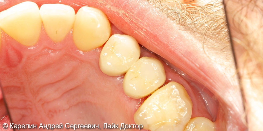 Удаление, отсроченная имплантация и протезирование зубов 1.4 и 1.5 - фото №11
