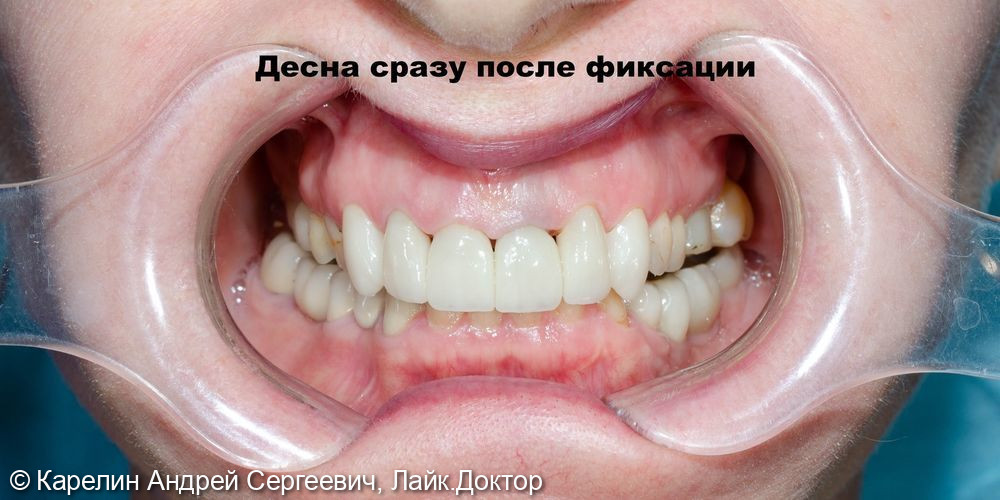 Виниры на передние верхние зубы фото 5 · Воронеж