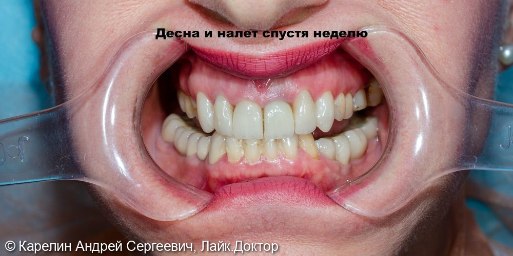 Виниры на передние верхние зубы фото 6 · Воронеж