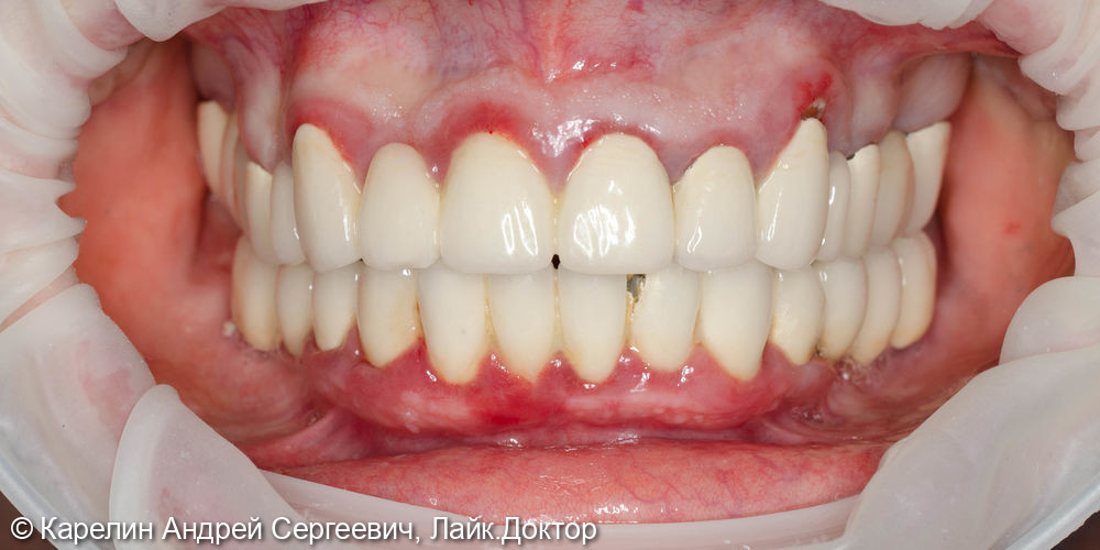 Тотальная реконструкция зубов верхней челюсти - фото №1