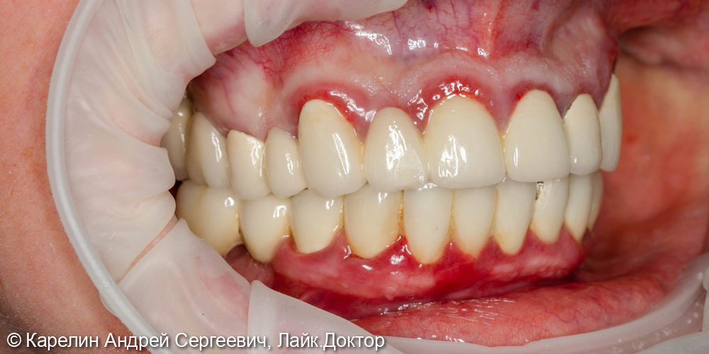 Тотальная реконструкция зубов верхней челюсти - фото №2