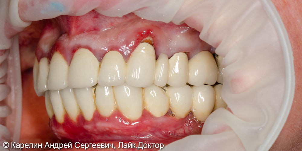 Тотальная реконструкция зубов верхней челюсти - фото №3