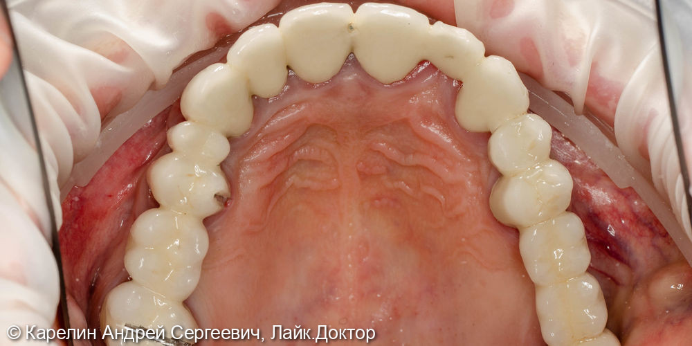 Тотальная реконструкция зубов верхней челюсти - фото №4