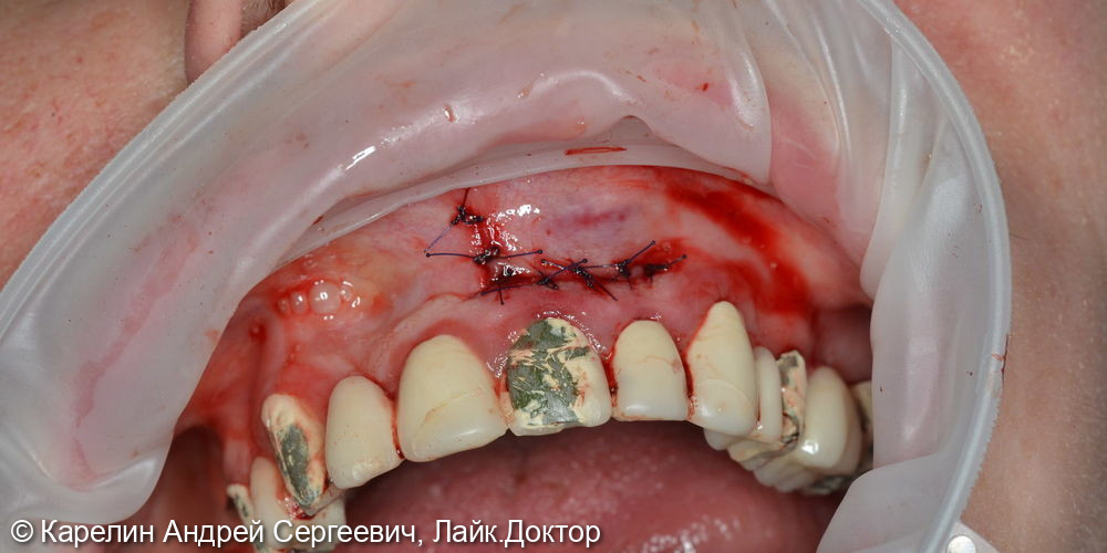 Тотальная реконструкция зубов верхней челюсти - фото №10