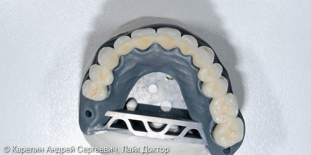 Тотальная реконструкция зубов верхней челюсти - фото №11