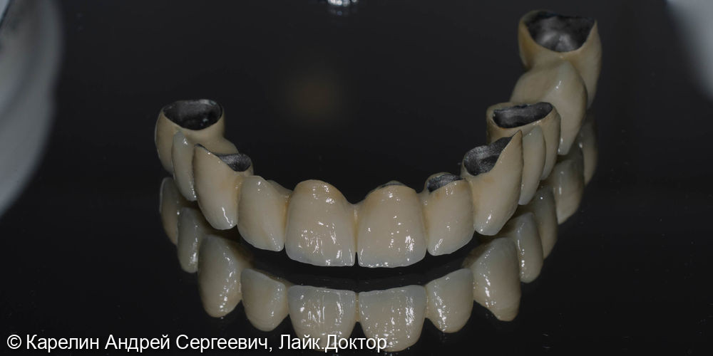 Тотальная реконструкция зубов верхней челюсти - фото №13