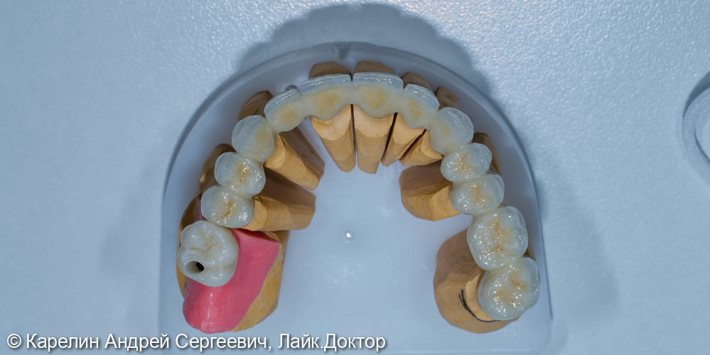 Тотальная реконструкция зубов верхней челюсти - фото №14