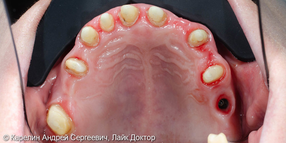 Тотальная реконструкция зубов верхней челюсти - фото №15