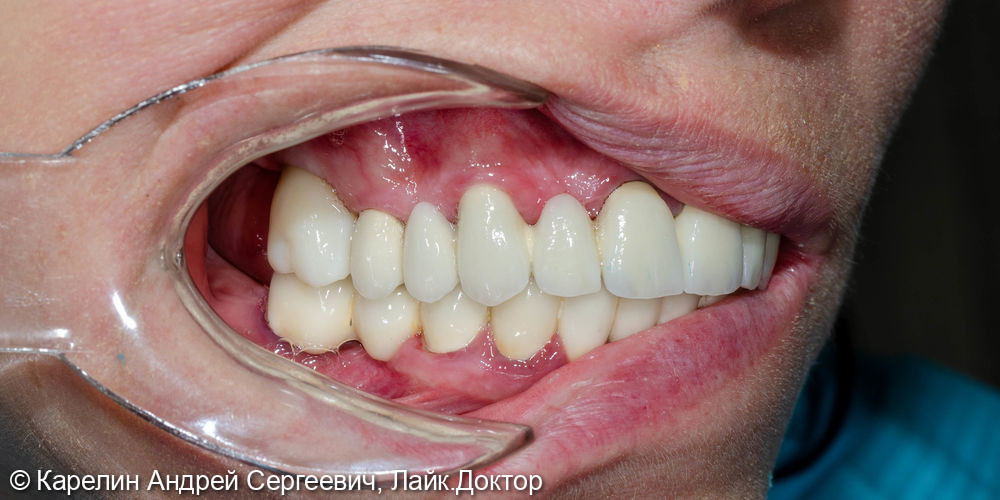 Тотальная реконструкция зубов верхней челюсти - фото №17