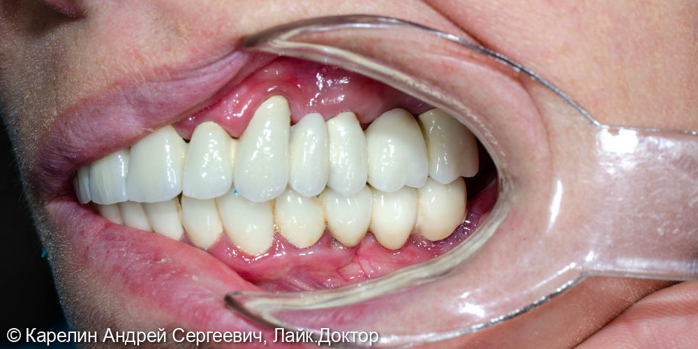 Тотальная реконструкция зубов верхней челюсти - фото №18