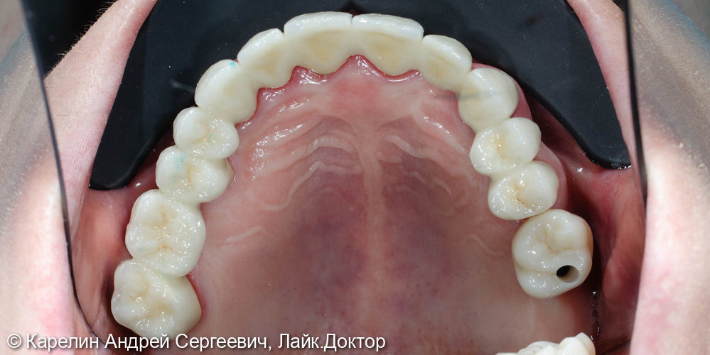 Тотальная реконструкция зубов верхней челюсти - фото №19