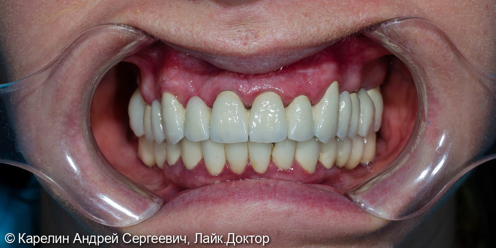 Тотальная реконструкция зубов верхней челюсти - фото №20