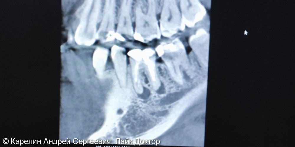 Лечение хронического гранулематозного периодонтита (кисты) зуба 3.6 - фото №1