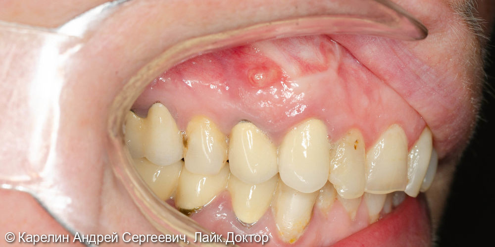 Удаление, одномоментная имплантация и протезирование зуба1.4 - фото №1