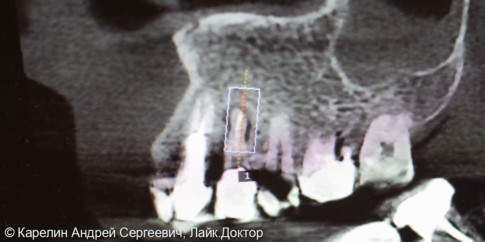 Удаление, одномоментная имплантация и протезирование зуба1.4 - фото №3