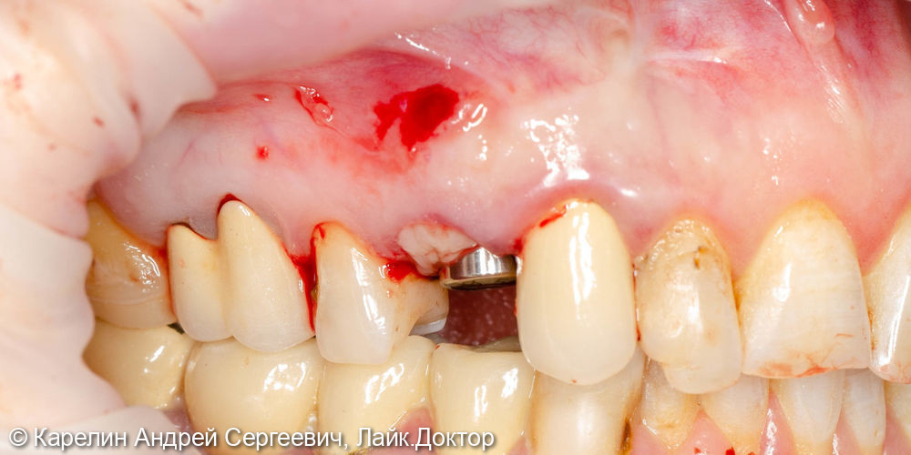 Удаление, одномоментная имплантация и протезирование зуба1.4 - фото №7