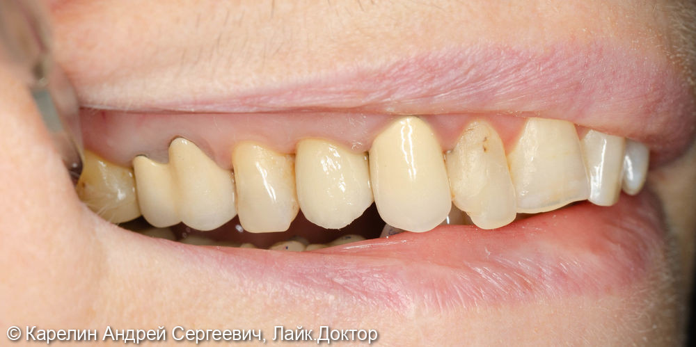 Удаление, одномоментная имплантация и протезирование зуба1.4 - фото №11