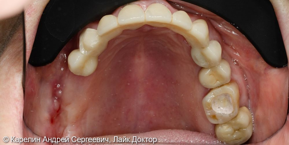 Тотальная реконструкция верхней и частичная нижней челюстей с помощью имплантатов и коронок на основе диоксида циркония - фото №3
