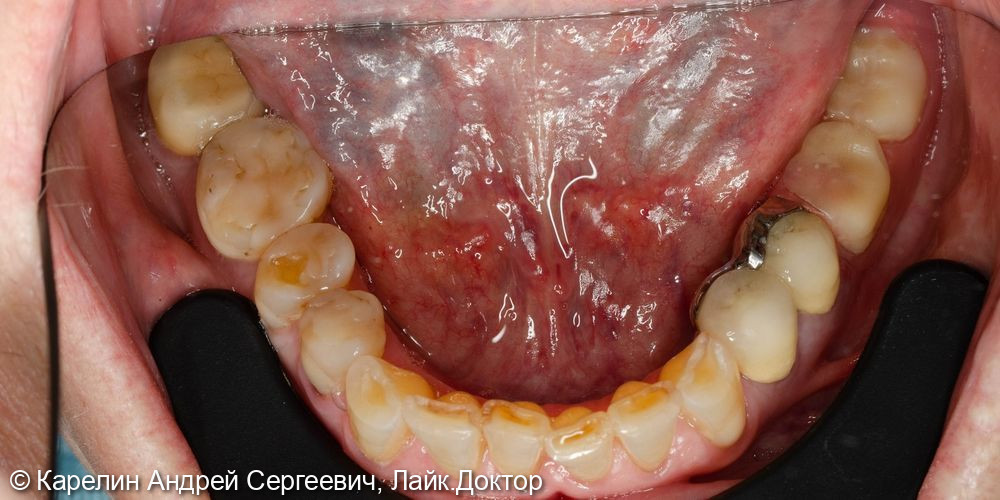 Тотальная реконструкция верхней и частичная нижней челюстей с помощью имплантатов и коронок на основе диоксида циркония - фото №4